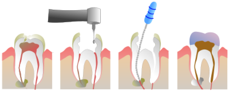 Endodoncja