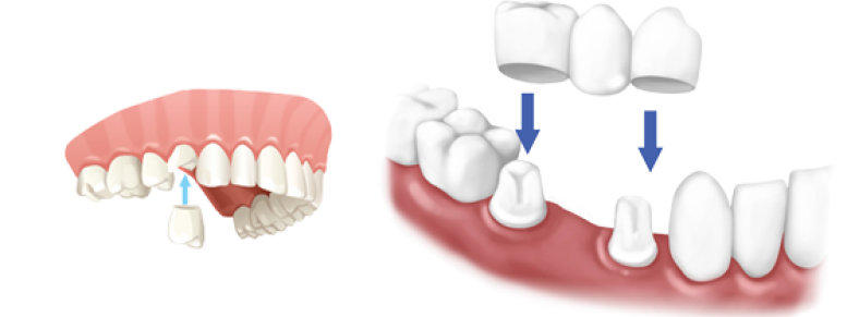 UZUPEŁNIENIA PROTETYCZNE STAŁE