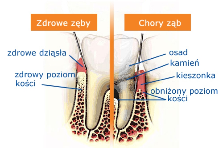 Leczenie chorób dziąseł